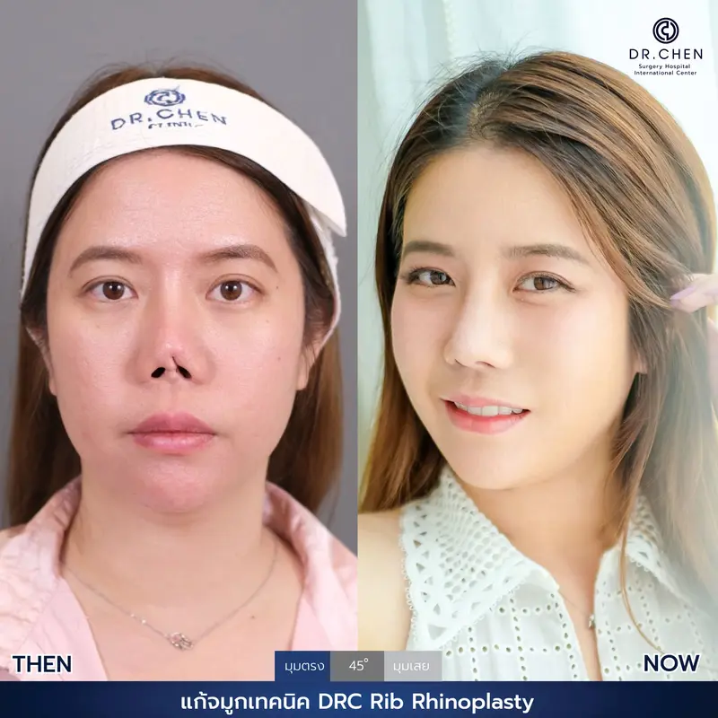 แก้จมูกเทคนิค DRC Rib Rhinoplasty