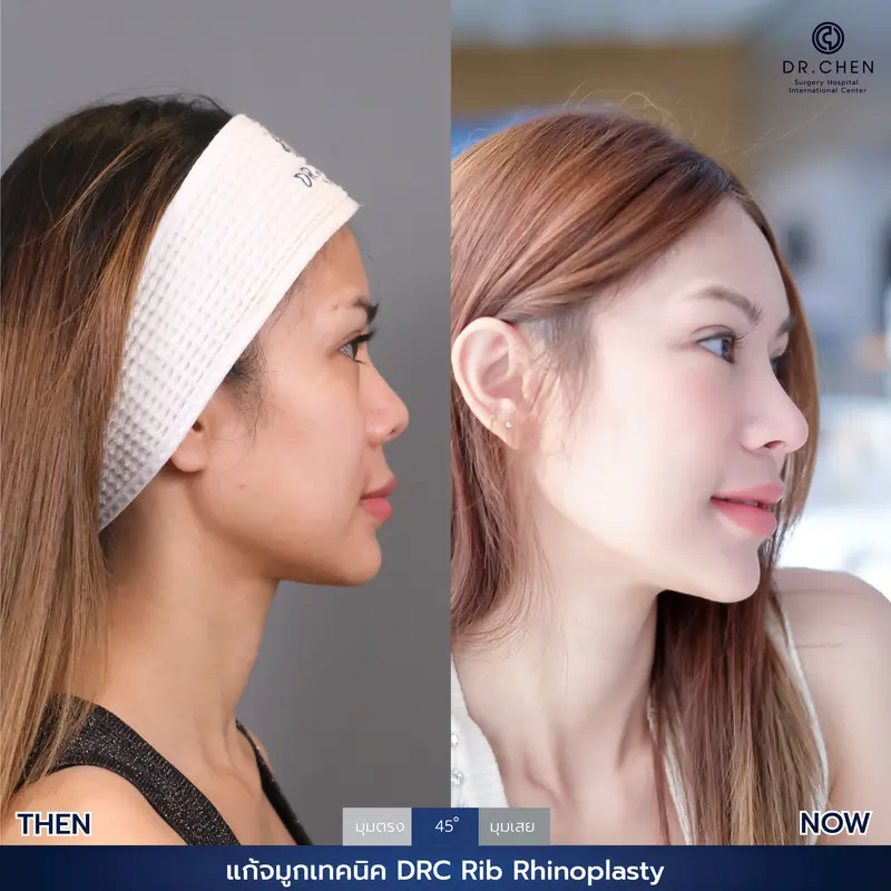 แก้จมูกเทคนิค DRC Rib Rhinoplasty