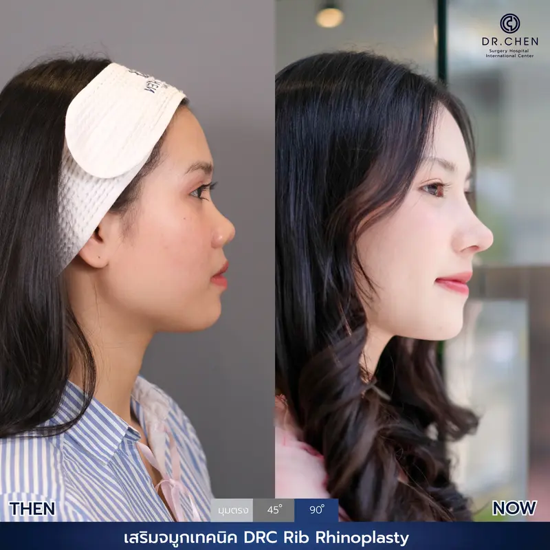 แก้จมูกเทคนิค DRC Rib Rhinoplasty