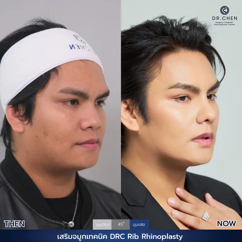 แก้จมูกเทคนิค DRC Rib Rhinoplasty