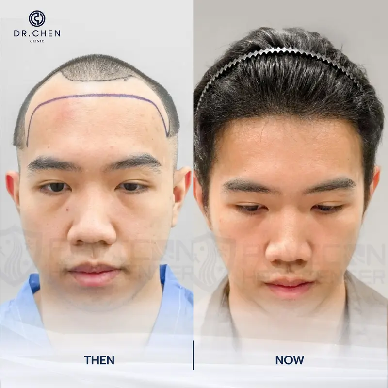 รีวิวปลูกผมผู้ชาย1