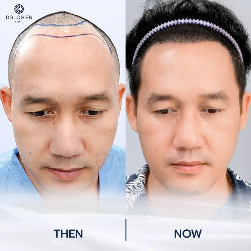 รีวิวปลูกผมผู้ชาย2