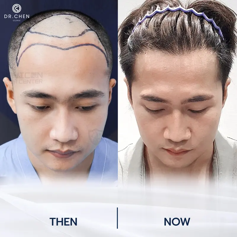 รีวิวปลูกผมผู้ชาย3