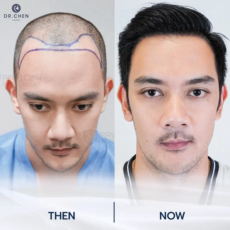 รีวิวปลูกผมผู้ชาย4