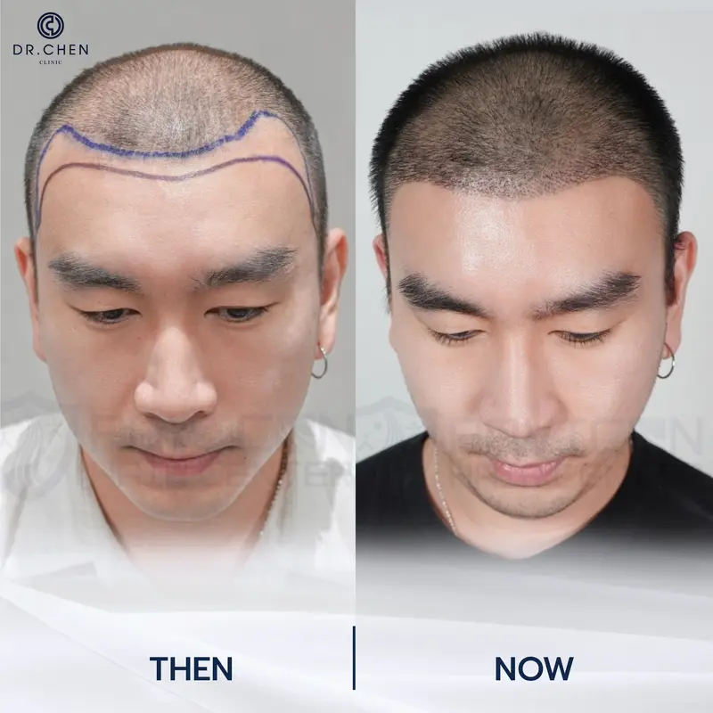 รีวิวปลูกผมผู้ชาย5