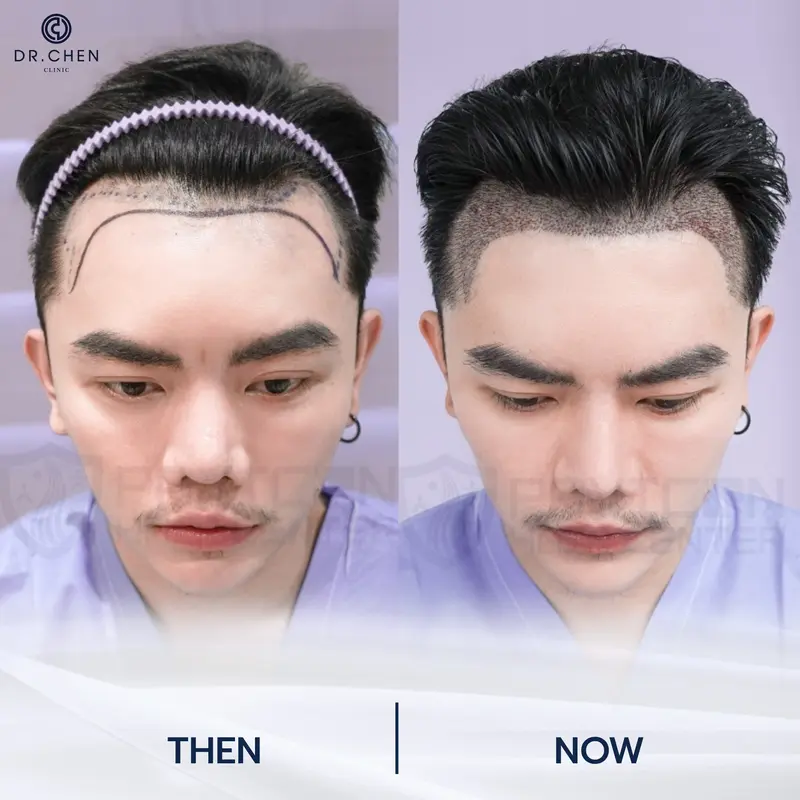 รีวิวปลูกผมผู้ชาย6