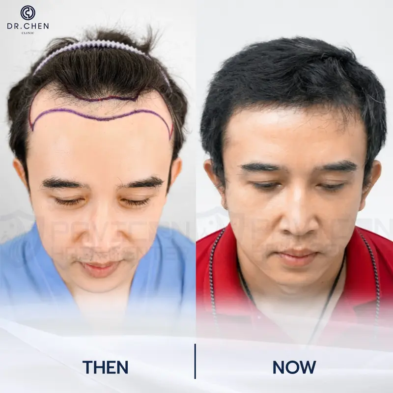 รีวิวปลูกผมผู้ชาย7