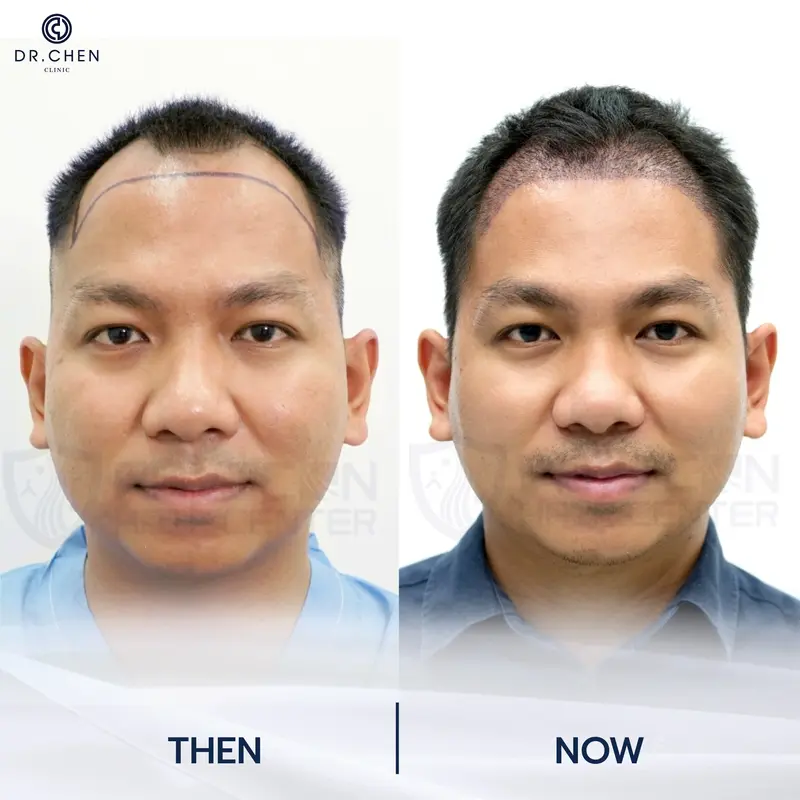 รีวิวปลูกผมผู้ชาย8