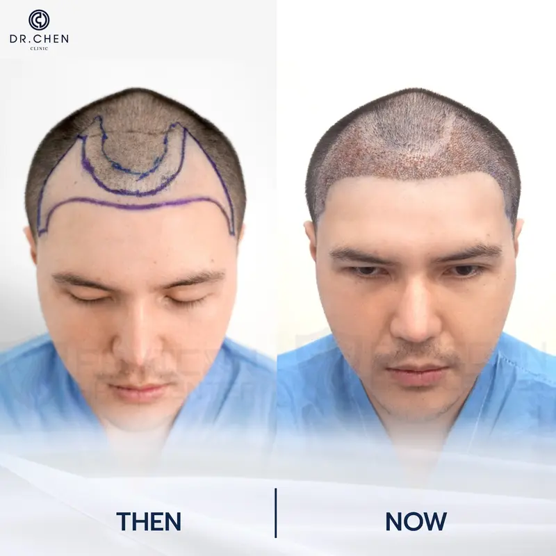 รีวิวปลูกผมผู้ชาย9