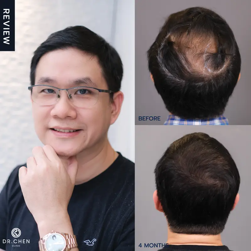 ปลูกผมผู้ชายอาจารย์เกน เชียงใหม่ ที่ Dr.Chen Clinic