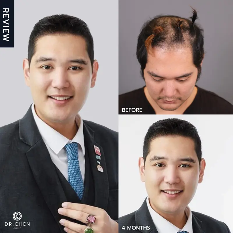 ปลูกผมผู้ชายคุณชารีฟเชียงใหม่ ที่ Dr.Chen Clinic