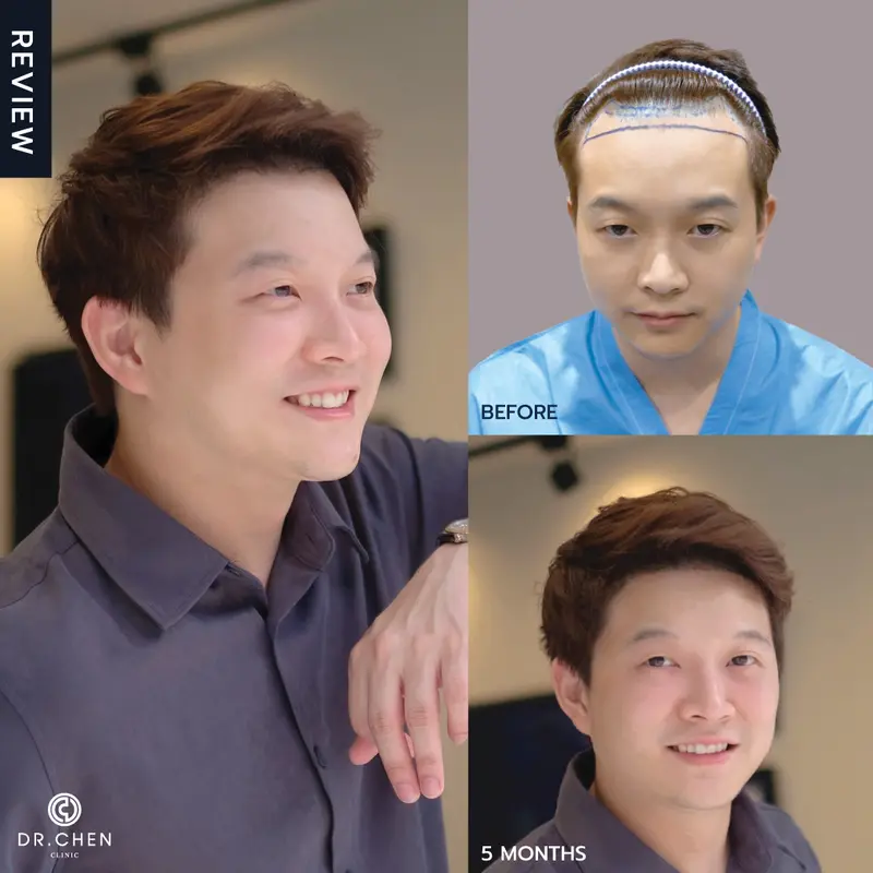 ปลูกผมผู้ชายคุณหมอเชนเชียงใหม่ ที่ Dr.Chen Clinic
