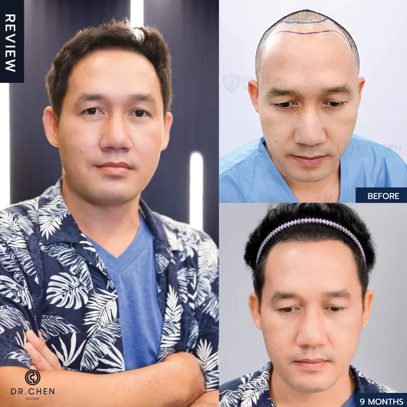 ปลูกผมผู้ชายเชียงใหม่ ที่ Dr.Chen Clinic