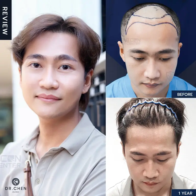 ปลูกผมส่วนหน้าผากผู้ชายเชียงใหม่ ที่ Dr.Chen Clinic