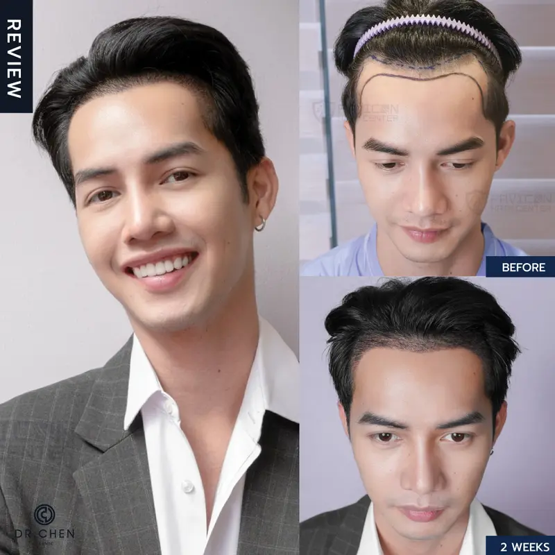 ปลูกผมชายเชียงใหม่