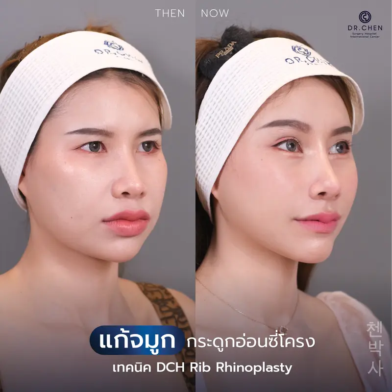 แก้จมูกซี่โครงตัวเอง