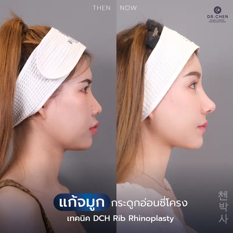 แก้จมูกซี่โครงตัวเอง