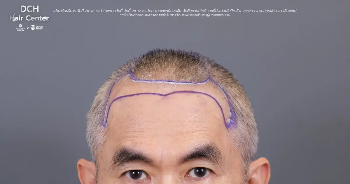 รีวิวปลูกผมถาวรที่ DCH Hair Center เติมผมที่หาย เติมความมั่นใจให้เกินร้อย