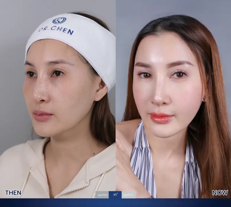 รีวิวศัลยกรรมปรับโครงหน้า