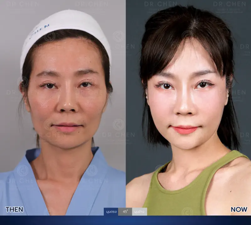 รีวิวศัลยกรรมปรับโครงหน้า