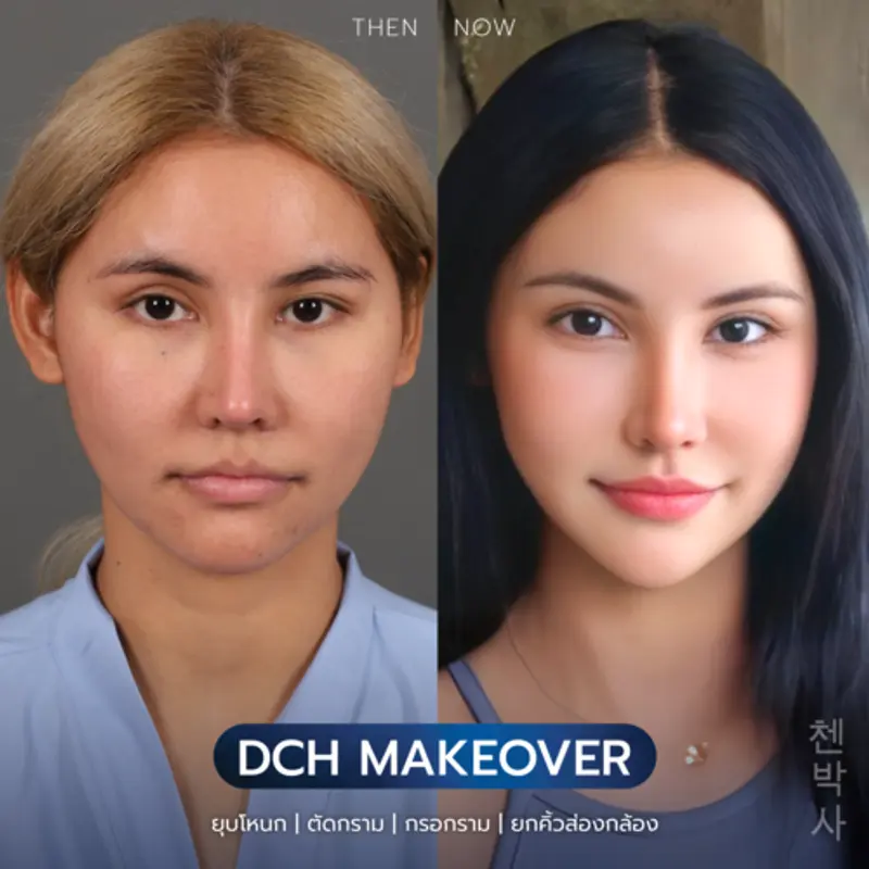 รีวิวศัลยกรรมปรับโครงหน้า