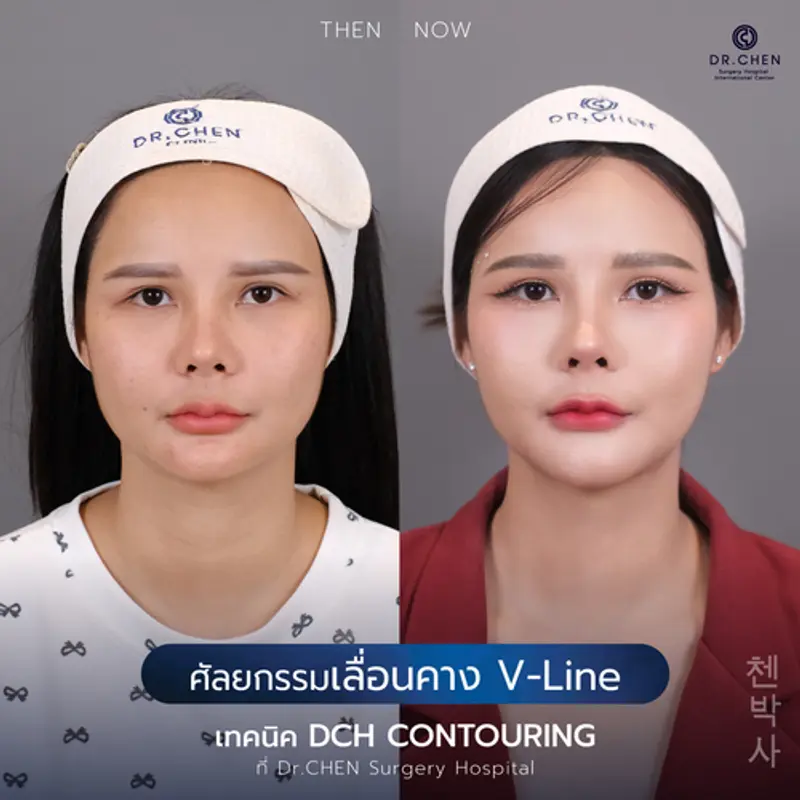 รีวิวศัลยกรรมปรับโครงหน้า
