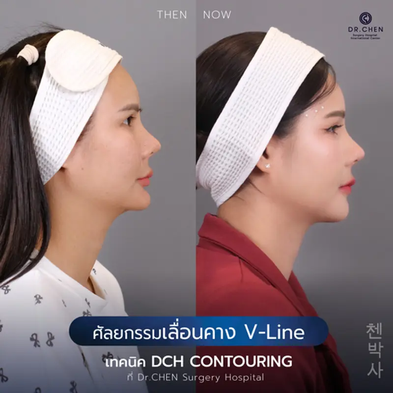 รีวิวศัลยกรรมปรับโครงหน้า