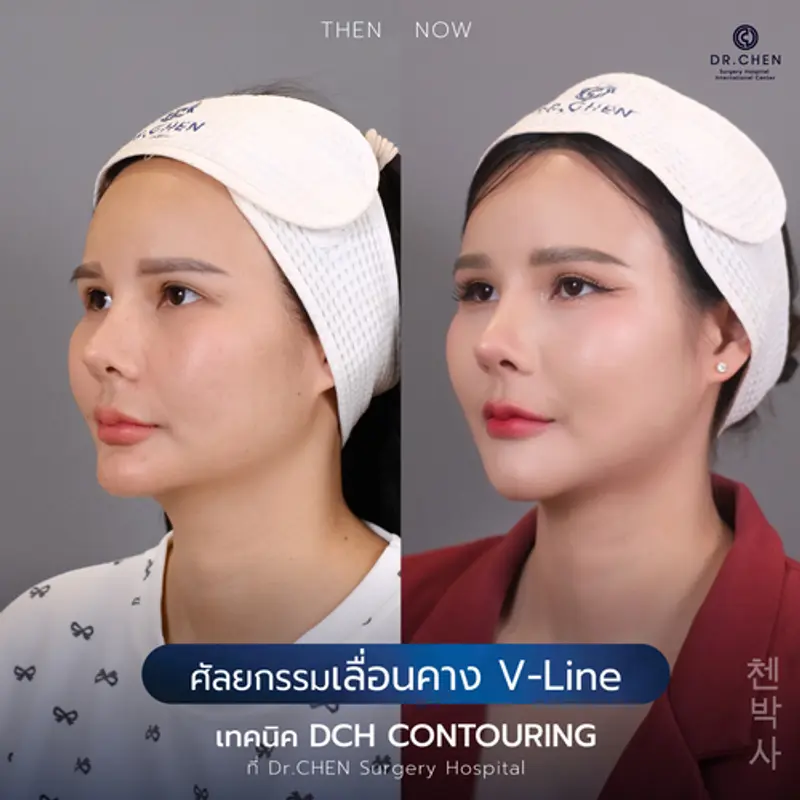 รีวิวศัลยกรรมปรับโครงหน้า