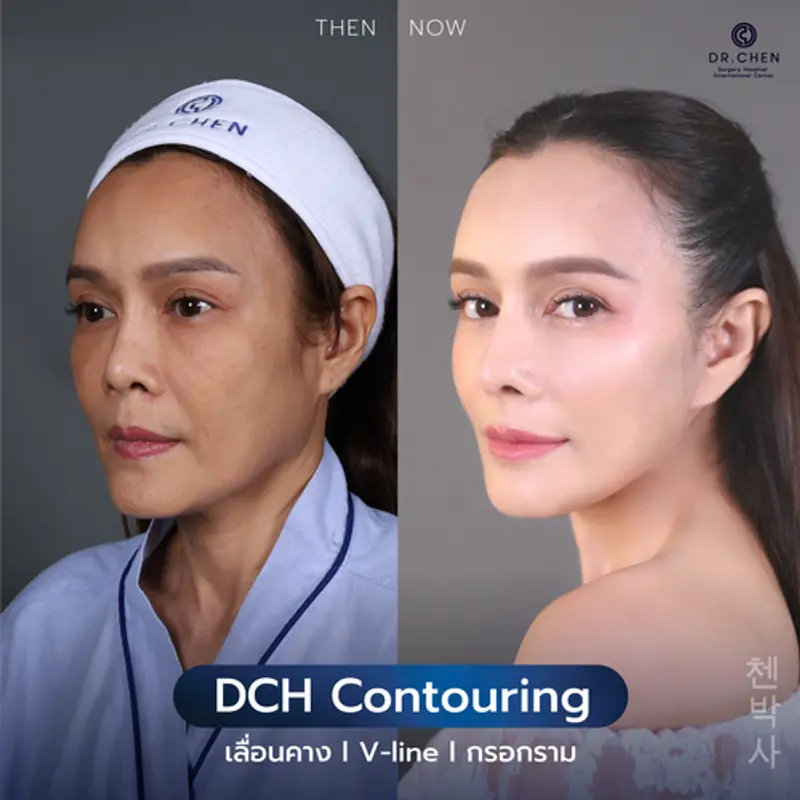 รีวิวศัลยกรรมปรับโครงหน้า