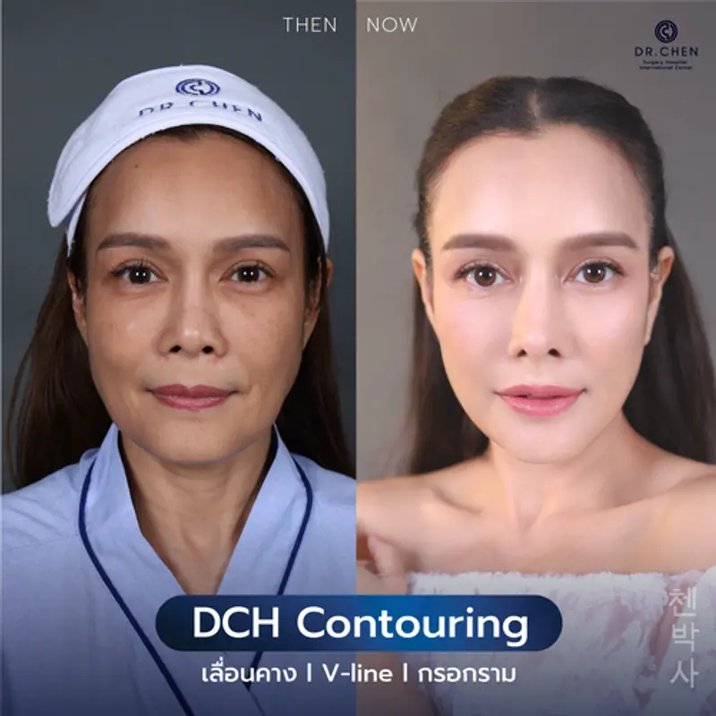 รีวิวศัลยกรรมปรับโครงหน้า