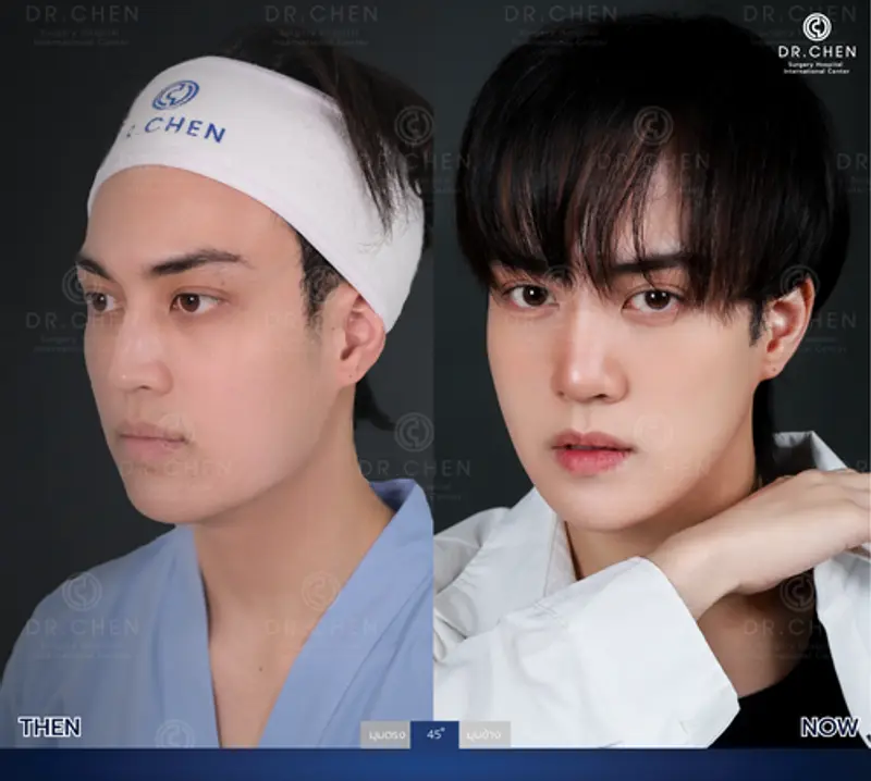 รีวิวศัลยกรรมปรับโครงหน้า