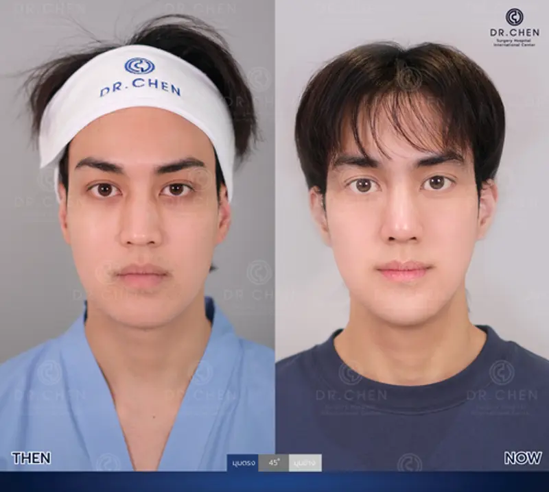 รีวิวศัลยกรรมปรับโครงหน้า