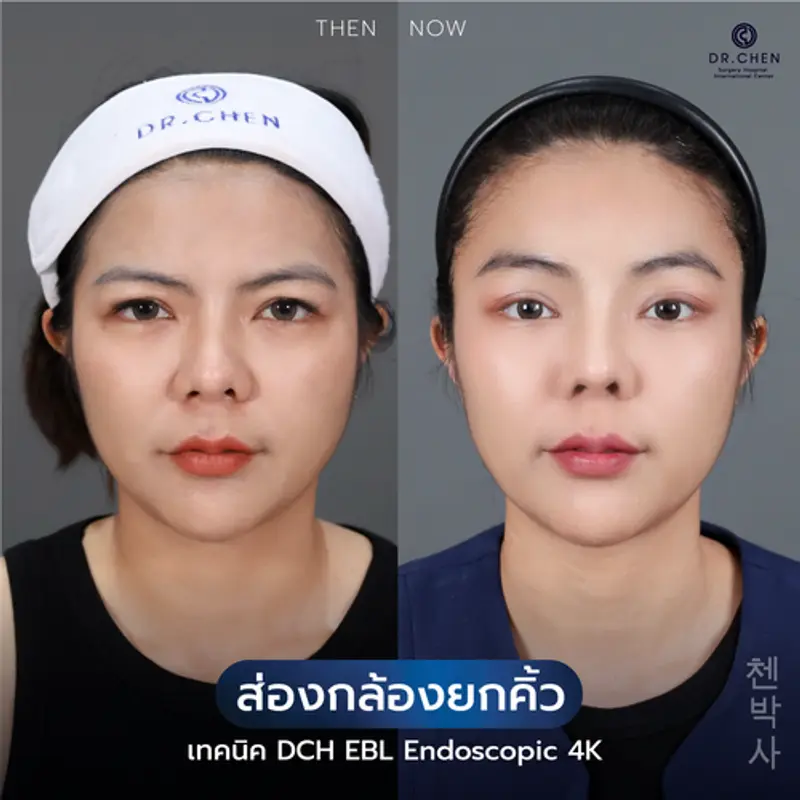 รีวิวศัลยกรรมยกคิ้ว