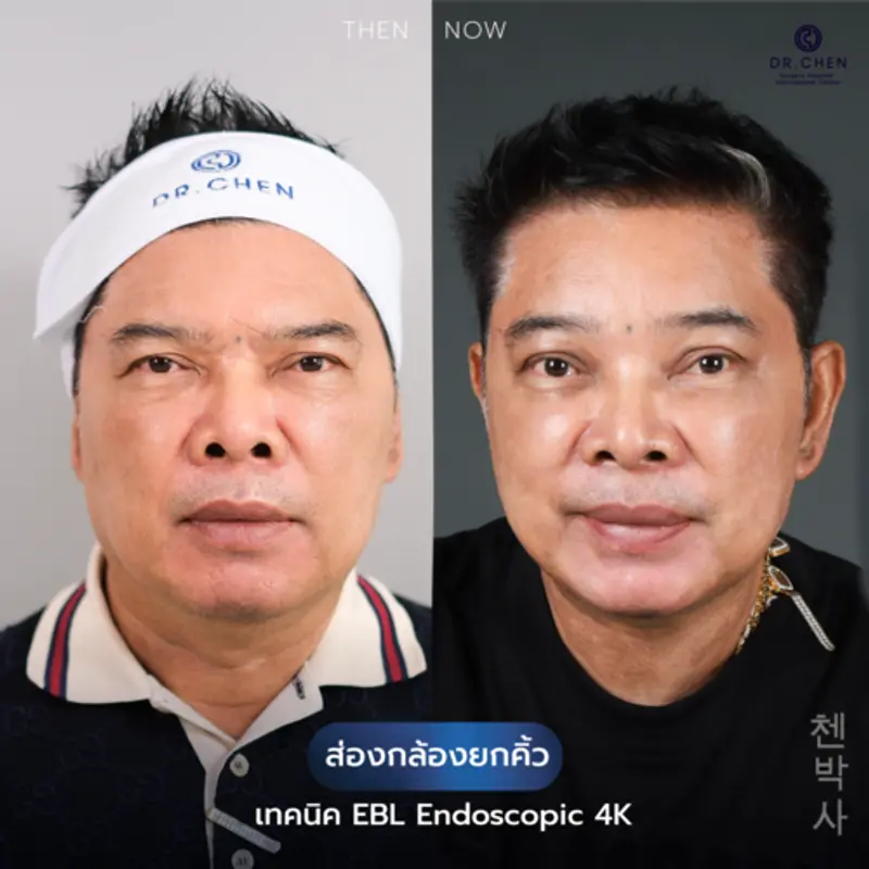 รีวิวศัลยกรรมยกคิ้ว