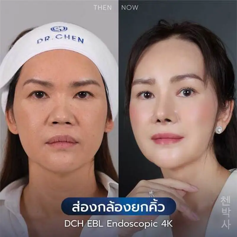 รีวิวศัลยกรรมยกคิ้ว