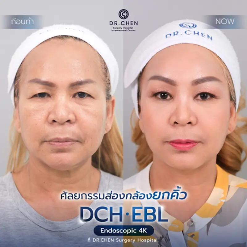 รีวิวศัลยกรรมยกคิ้ว