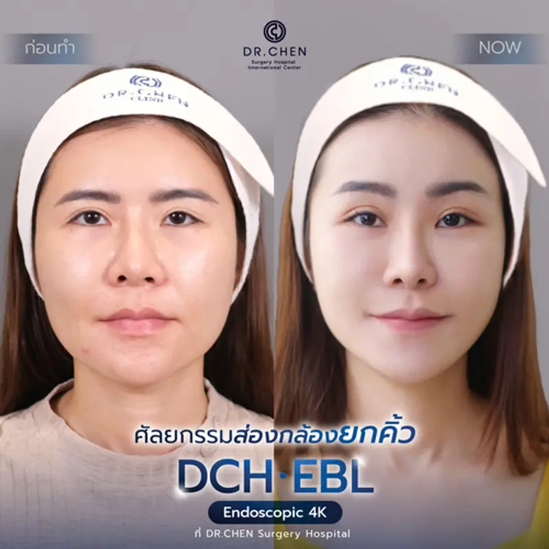 รีวิวศัลยกรรมยกคิ้ว