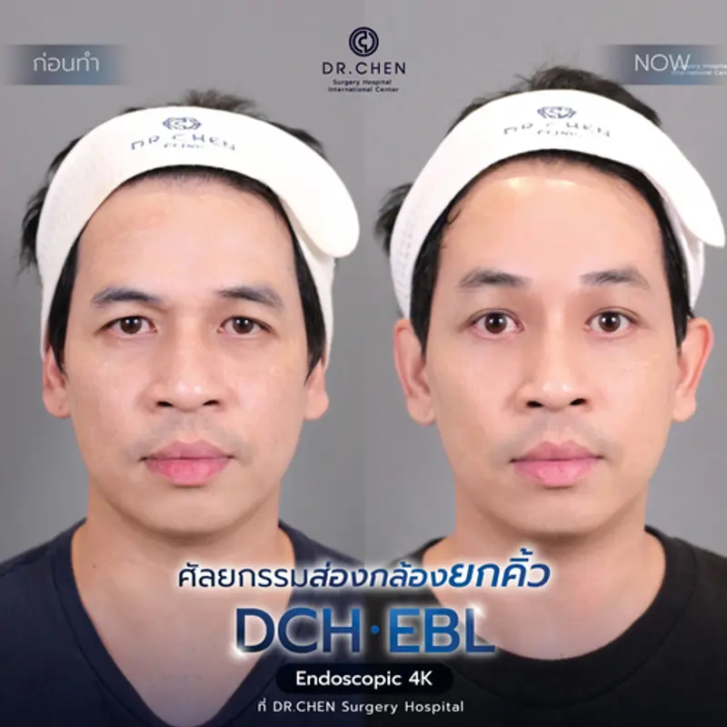 รีวิวศัลยกรรมยกคิ้ว