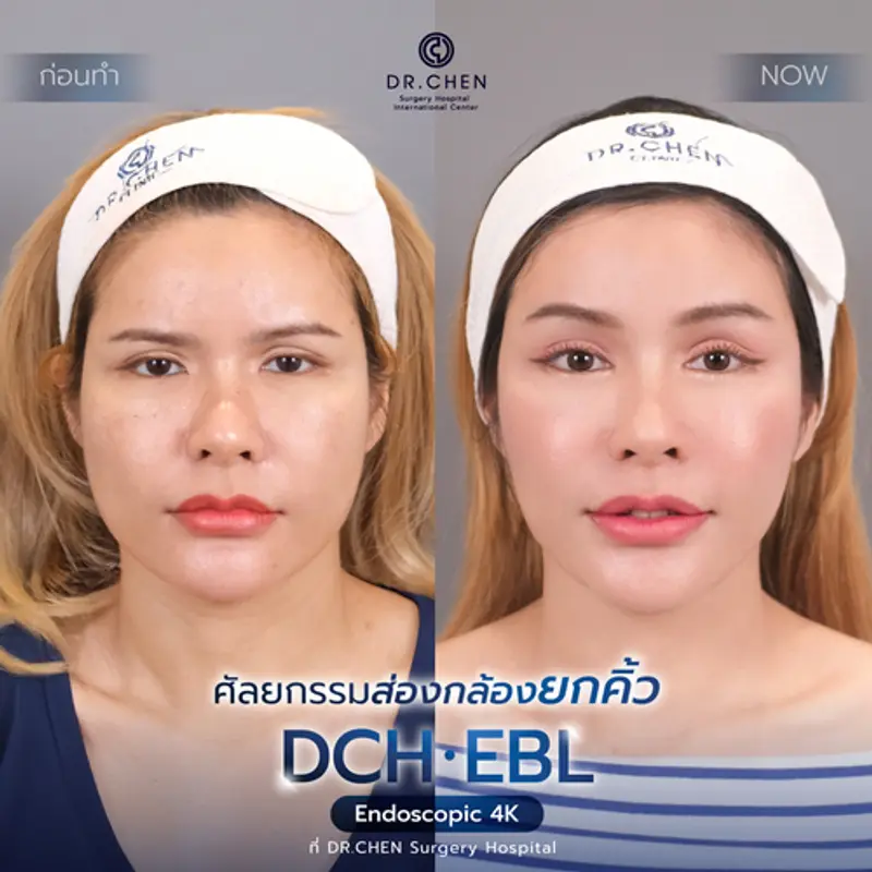 รีวิวศัลยกรรมยกคิ้ว