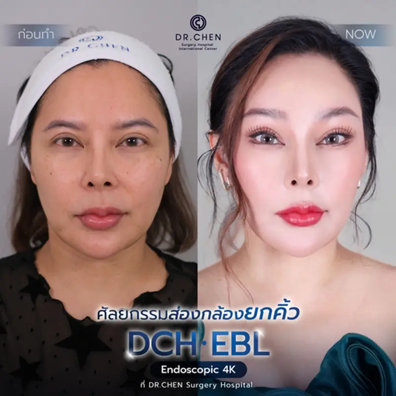 รีวิวศัลยกรรมยกคิ้ว