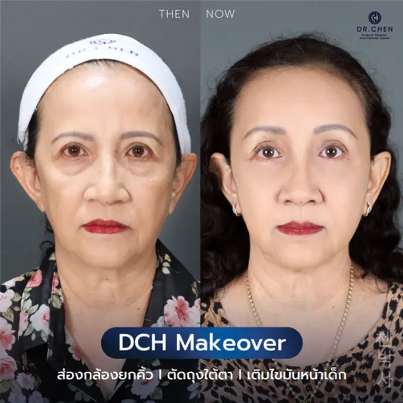 รีวิวเติมไขมันหน้าเด็ก