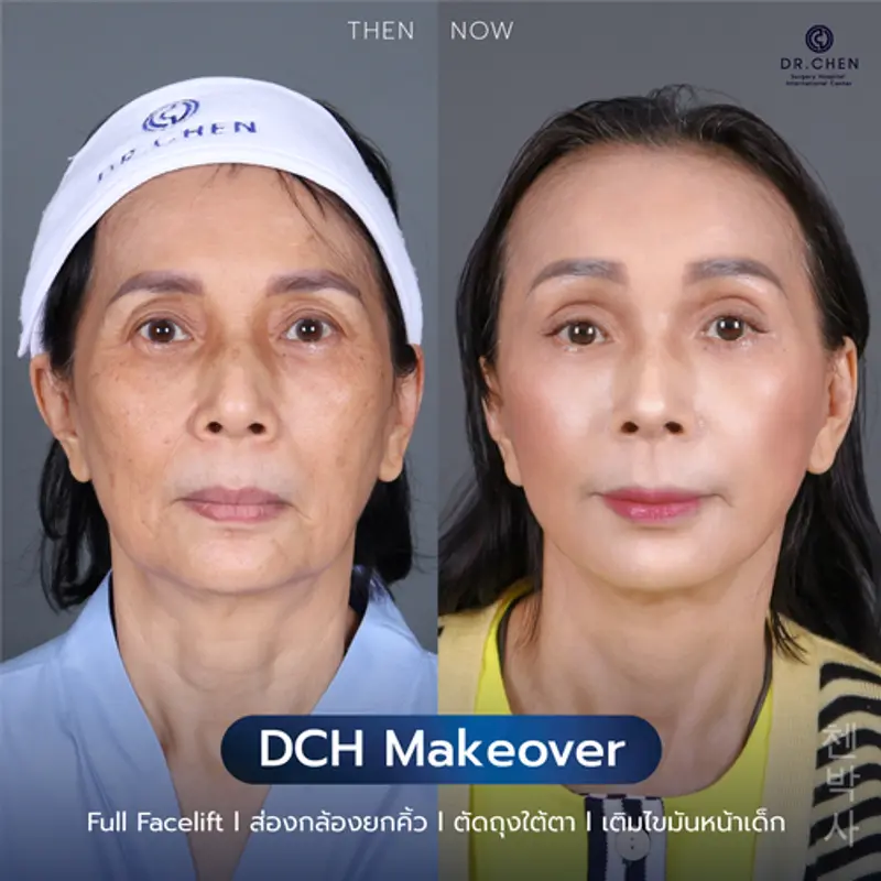 รีวิวเติมไขมันหน้าเด็ก