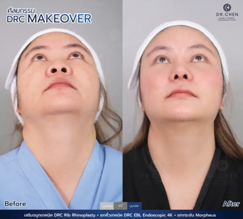 รีวิวศัลยกรรมดึงหน้า