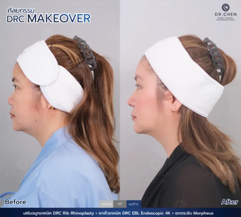 ศัลยกรรมดึงหน้า