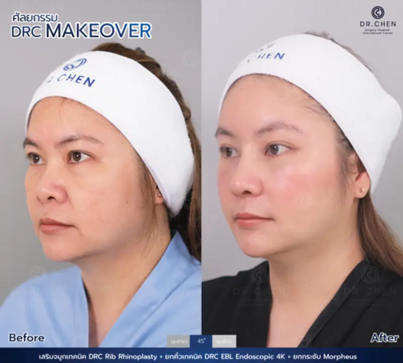 รีวิวศัลยกรรมดึงหน้า