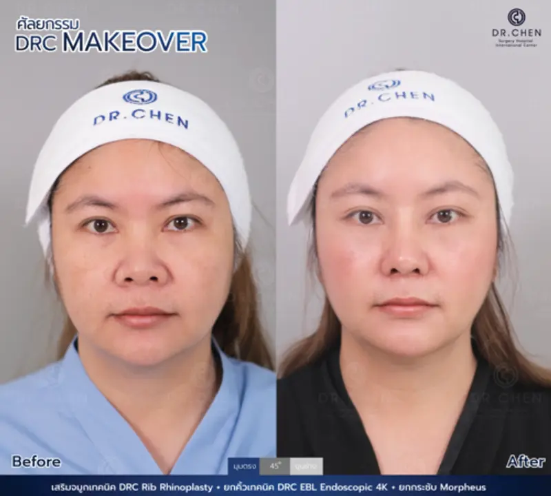 รีวิวศัลยกรรมดึงหน้า