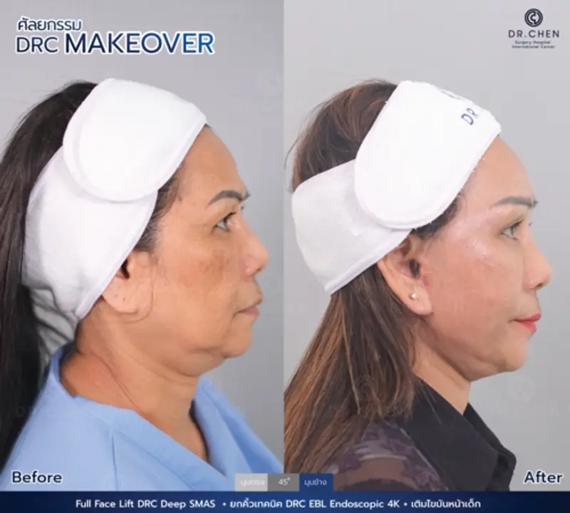 รีวิวศัลยกรรมดึงหน้า