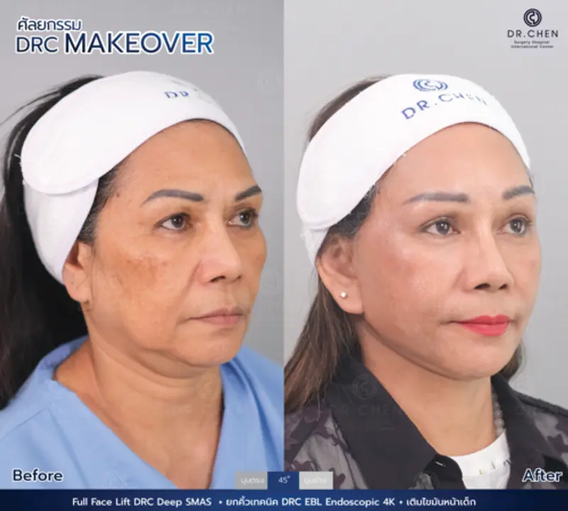 รีวิวศัลยกรรมดึงหน้า