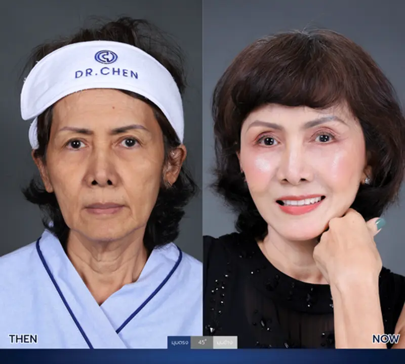 รีวิวศัลยกรรมดึงหน้า