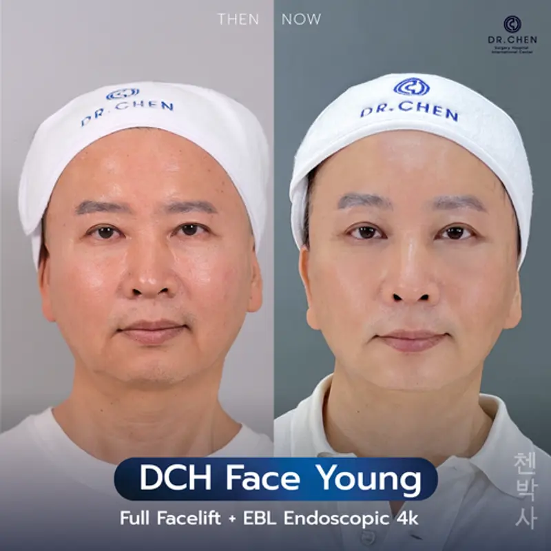 รีวิวศัลยกรรมดึงหน้า